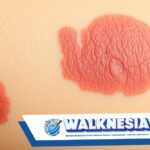 Menyingkap Tabir Psoriasis: Antara Harapan Kesembuhan dan Realitas Medis